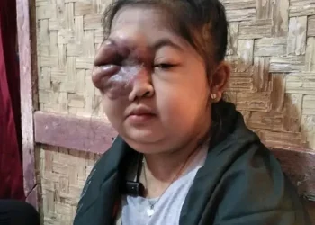 Riesta Lestari Siswi SMKN 6 Garut Sudah 10 Bulan Menderita Penyakit Kanker Ganas